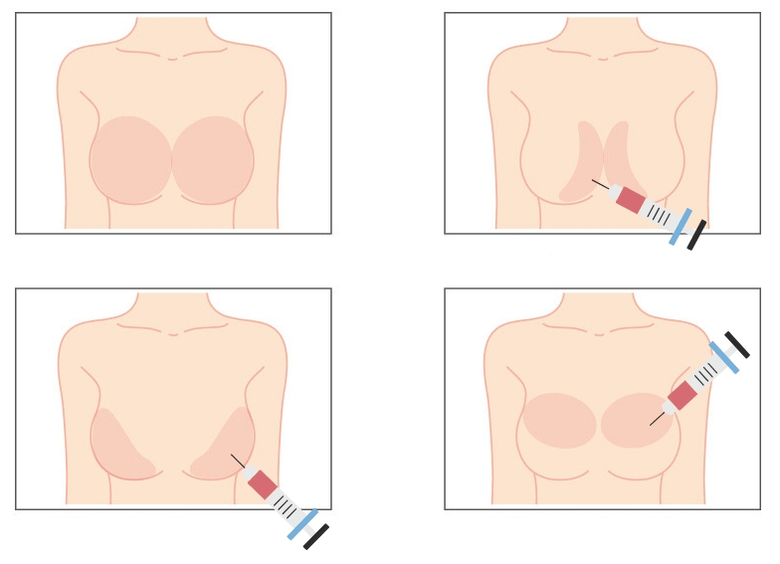 Mesta za injiciranje hialuronske kisline v dojke