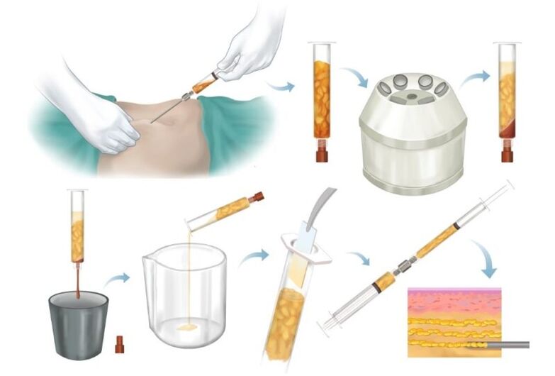 Odstranjevanje maščobe s problematičnih predelov, obdelava in vbrizgavanje v tkivo dojke