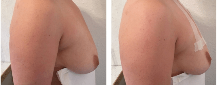 Pred in po dvigu prsi z nitmi