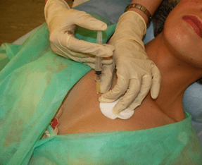 Vnos mezokoktajla v tkivo dojke - alternativa injekcijam hialuronske kisline